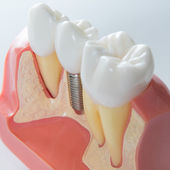 protez-zuba
