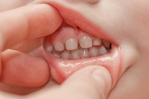 Серебрение молочных зубов 