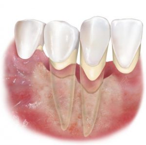 Своевременное лечение пародонтоза спасет ваши зубы от разрушения